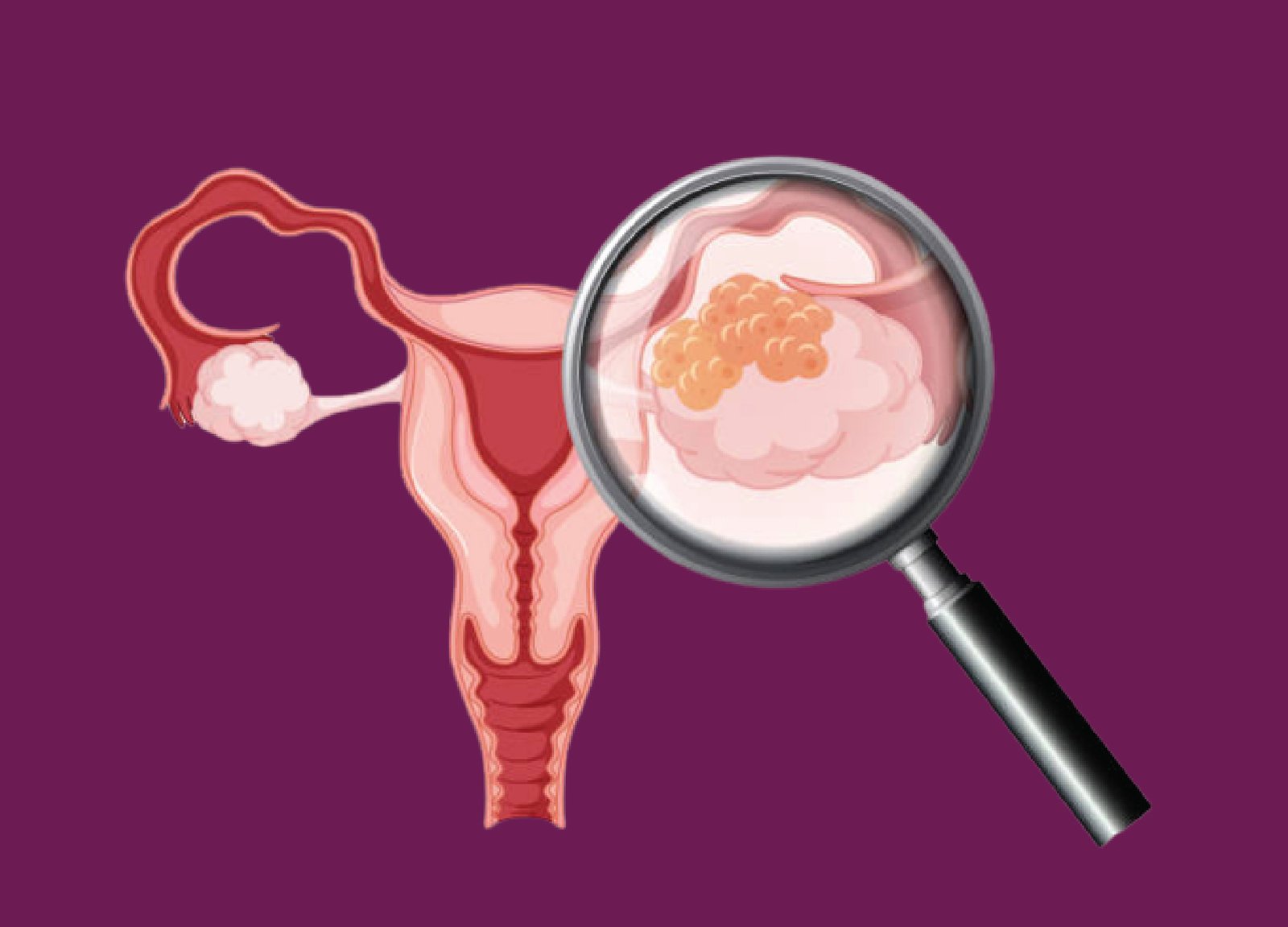 Ovarian Cancer: Understanding, Detecting, and Treating This Serious Condition