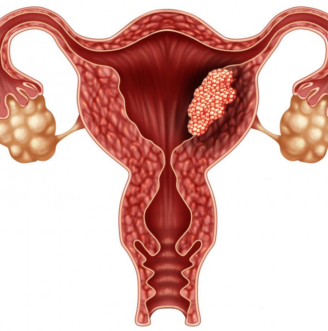 Preventing Uterine Cancer