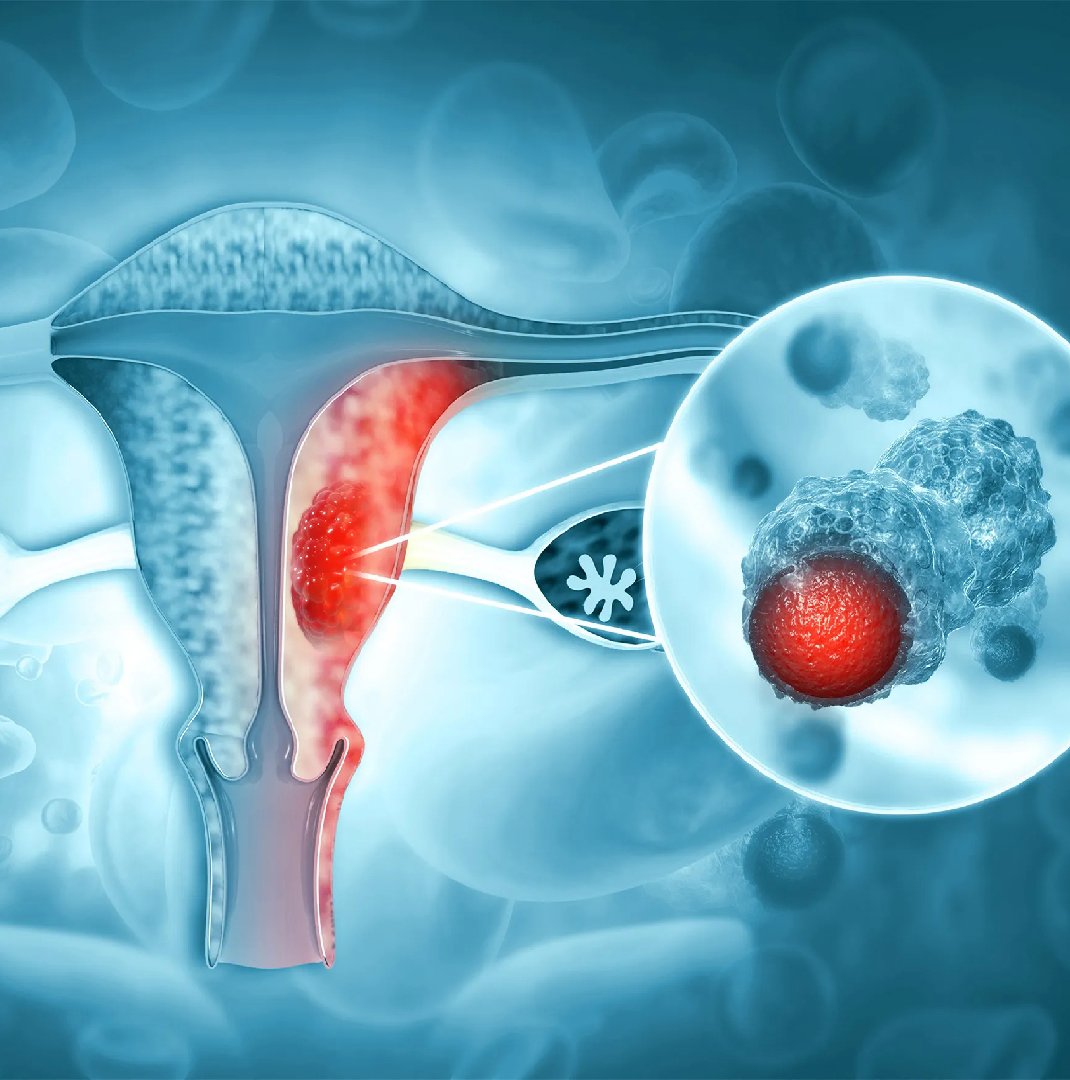 Molecular Markers in Uterus Cancer