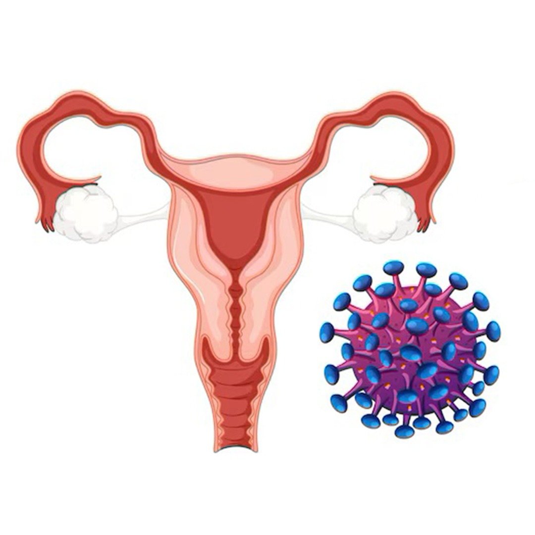 Stages of Vulvar Cancer