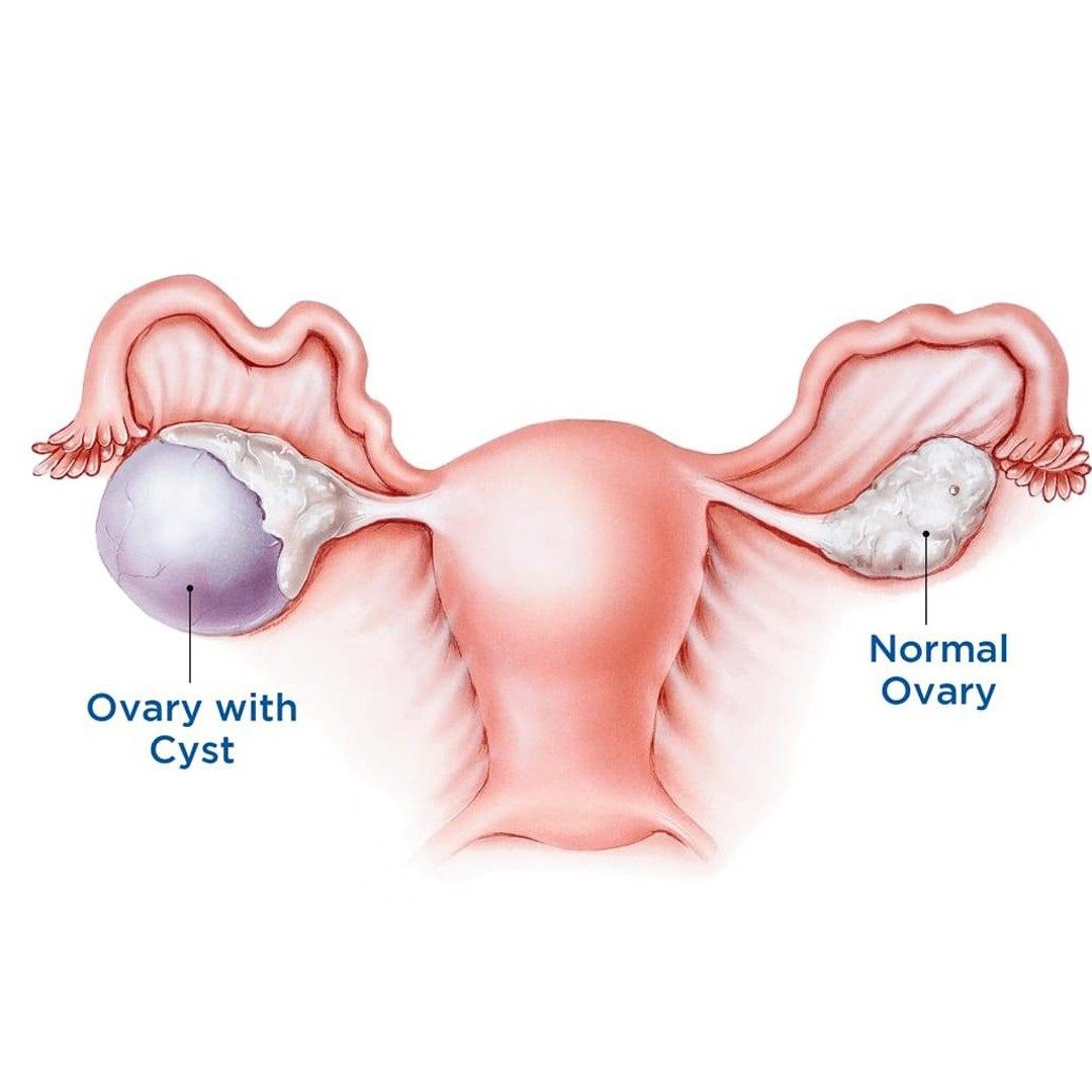 Causes of Ovarian Cysts