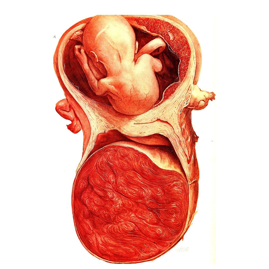 Types of Gestational Trophoblastic Disease