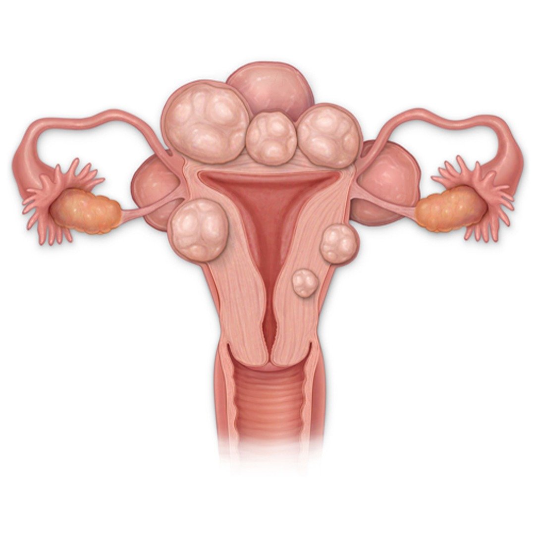 What Are Uterine Fibroids?