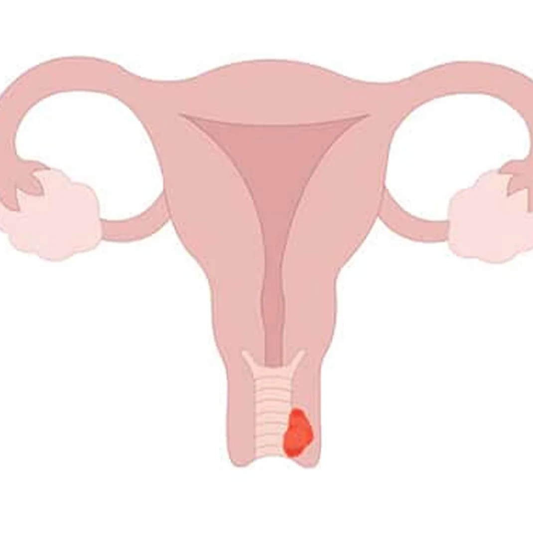 What Is Vaginal Cancer? A Detailed Guide to Understanding, Diagnosing, and Treating Vaginal Cancer